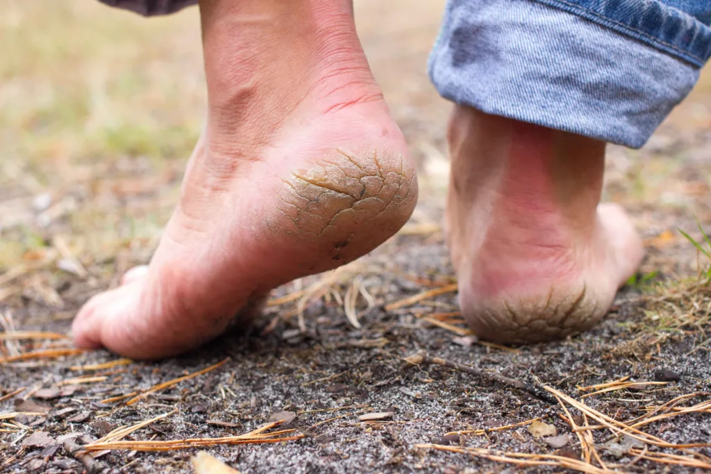 A person's feet, showing their dry, cracked heels after a long summer of trail hiking, water sports and sandal wearing, creating dry, cracked skin, dead skin cells, and other foot problems. This person is in dire need of a pedicure at Panache Day Spa near Boise, ID.
